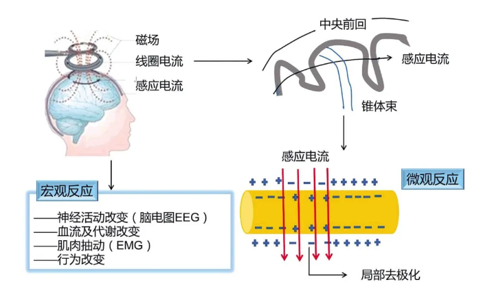 神奇的"经颅磁刺激"了解一下!