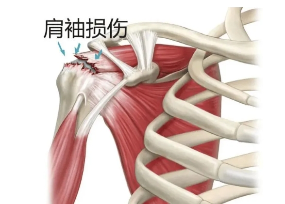 肩膀袖损伤示意图